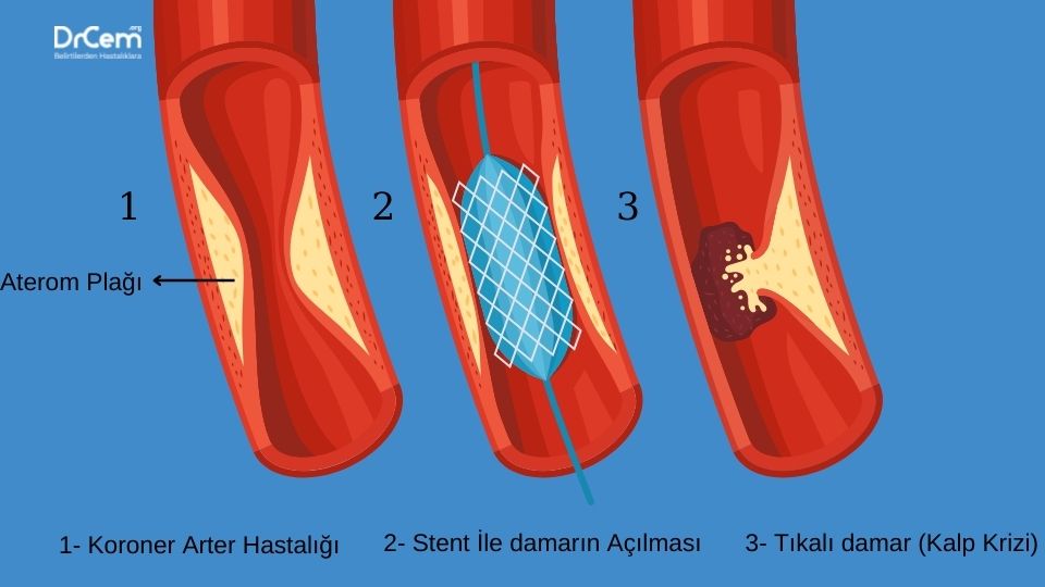 Kalp Krizi görseli - DrCem hastalık rehberi